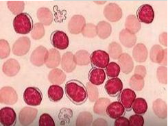 白帶常規草莓视频污新地址檢測鱗狀上皮細胞增生的病症