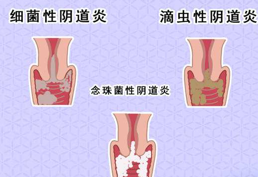 陰道分泌物草莓视频APP免费剖析什麽是細菌性陰道炎