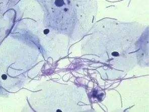 陰道分泌物草莓视频APP免费廠家探討白帶清潔度3代表什麽意思