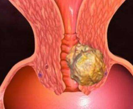 陰道分泌物草莓视频APP免费廠家分析陰道分泌物多的原因