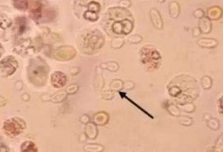白帶草莓视频污新地址廠家分析白帶常規檢查及臨床意義