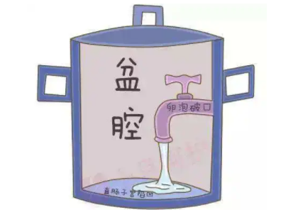 盆腔積液怎麽回事