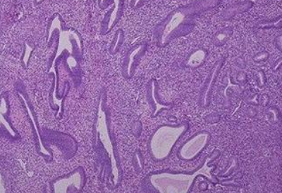 下體一直出血可能與子宮內膜厚有關 下體一直出血可能與子宮內膜厚有關